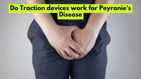 Do Traction Devices Work For Peyronies Disease