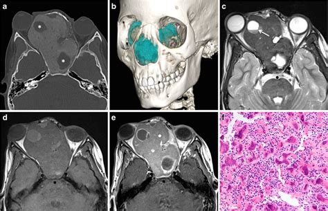 Juvenile Psammomatoid Ossifying Fibroma Jpof In A 10 Year Old Girl