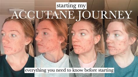 Accutane Month Cystic Hormonal Acne What To Expect On Accutane