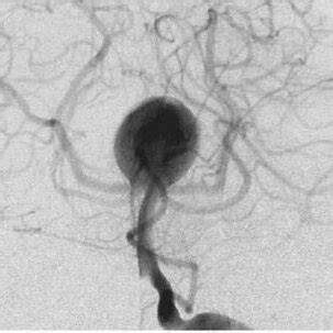 Digital Subtraction Angiography Image Of Intracranial A Fusiform