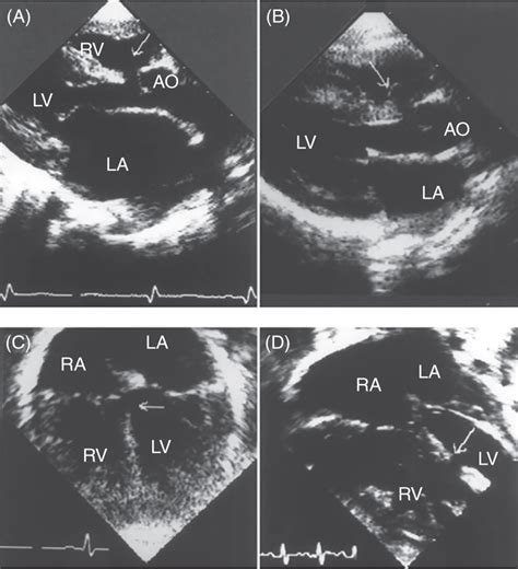 Ventricular Septal Defect Thoracic Key