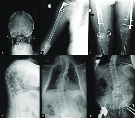 Conventional Radiographs A Skull With Signs Of Craniotomy B