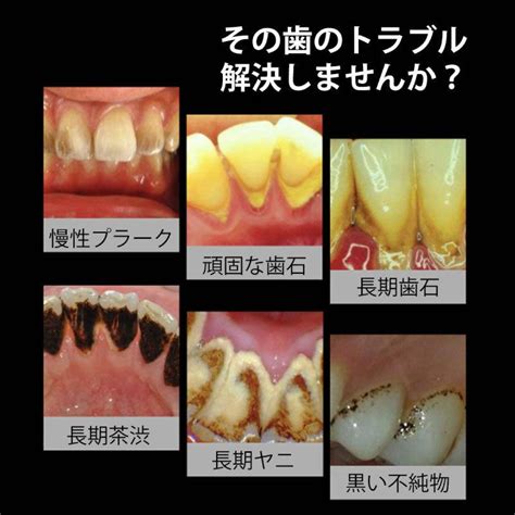 歯石取り 歯石とり プロ用 歯石取 除去 歯石を自分で取る オーラルケア デンタルケア 在宅 自宅用 スケーラー 歯石 歯 ヤニ取り しこう