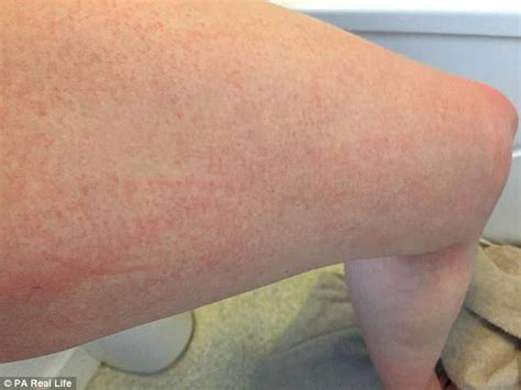 Mother reveals how a WATER 'allergy' left her covered in red welts | Daily Mail Online