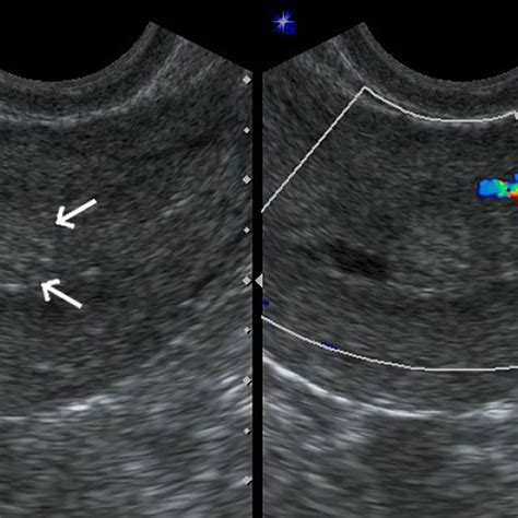 Pdf Post Molar Stage I Low Risk Gestational Trophoblastic Neoplasia Transvaginal Ultrasound