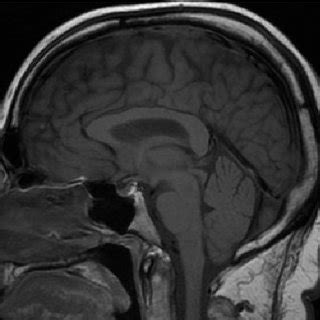 Sagittal T Weighted Magnetic Resonance Image Showing Restoration Of