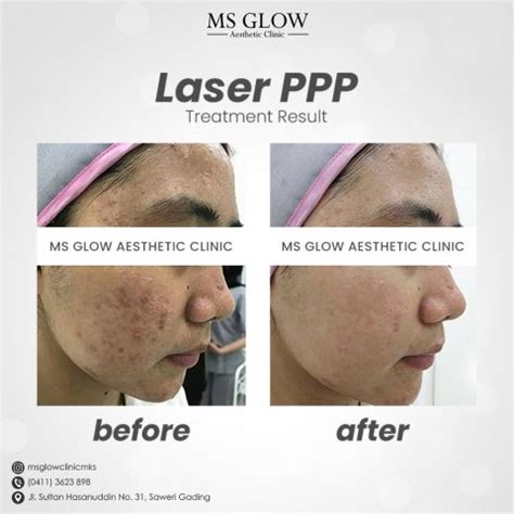 Treatment Laser Treatment MS Glow Aesthetic Clinic