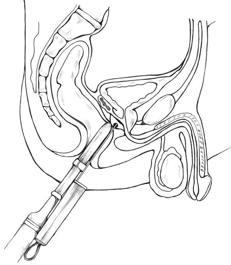 Transrectal Prostate Biopsy With An Ultrasound Probe Guiding The Needle