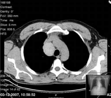 Radiogra Fi A Pulmonar Incid Ncia Posteroanterior E Per Fi L