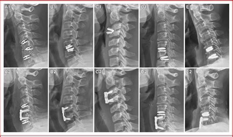 Figure 1 From Incidence And Risk Factor Of Implant Dislocation After