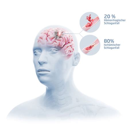 Schlaganfall Krankheitsbilder Bort