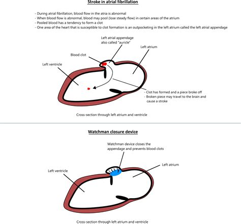 Anatomy Of Left Atrial Appendage