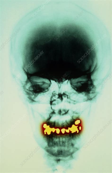 Dental Fillings X Ray Stock Image M782 0193 Science Photo Library