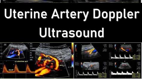 Uterine Artery Doppler Ultrasound Interpretation Doppler Ultrasound 201