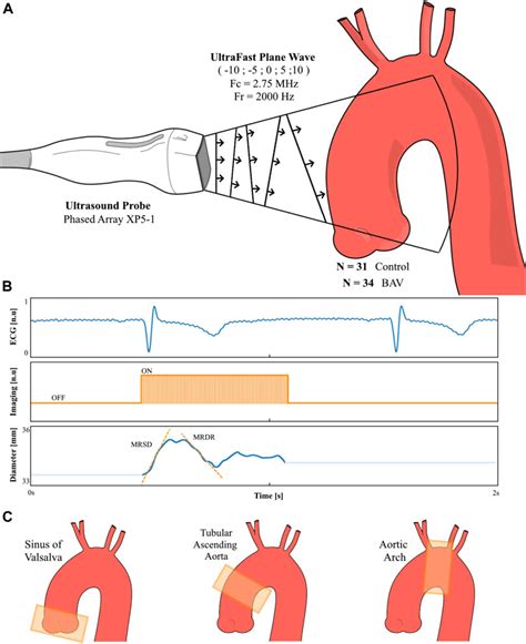 Frontiers Methods Aortic Wall Deformation Assessment By Ultrafast Ultrasound Imaging