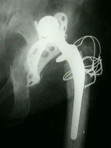 Dislocation Of Tha Wheeless Textbook Of Orthopaedics