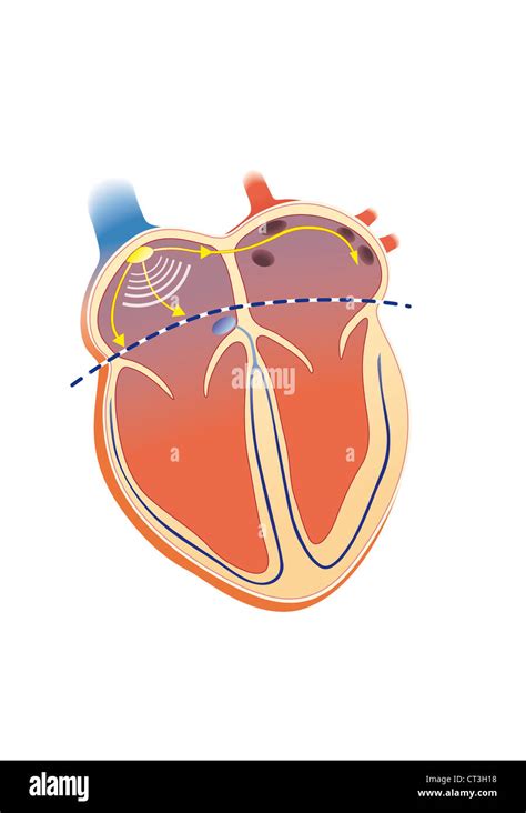 ATRIOVENTRICULAR BLOCK Stock Photo - Alamy