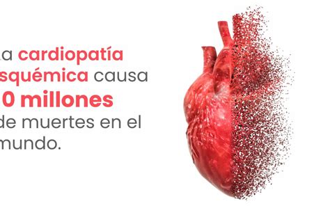 La cardiopatía isquémica causa 10 millones de muertes en el mundo