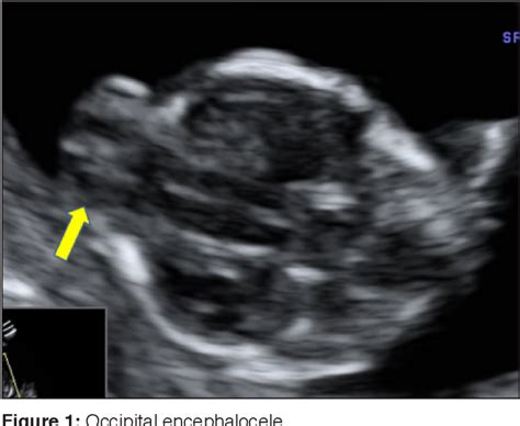 Figure 1 From Prenatal Sonographic Diagnosis Of Meckel Gruber Syndrome A Case Report Semantic