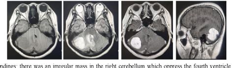 Figure 1 From Intracranial Hemangiopericytoma With Right Sided Aortic