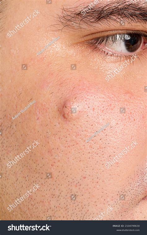 Sebaceous Cyst Images Stock Photos Vectors Shutterstock