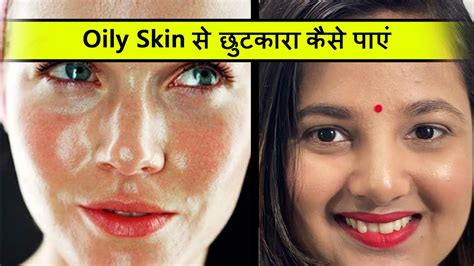 How To Get Rid Of Oily Skin Oily Skin से छुटकारा कैसे पाए Oily Skin