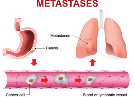 New Research Provides Insight Regarding Cancer Metastasis