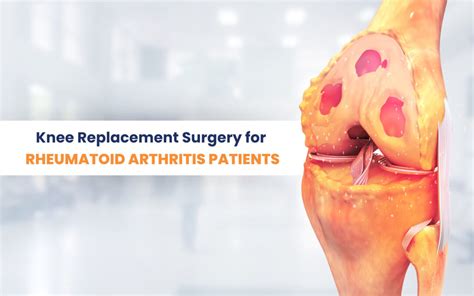 Knee Replacement Surgery for Rheumatoid Arthritis Patients: A Game ...