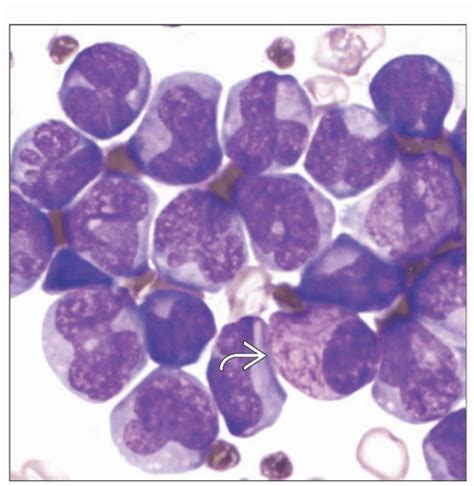 Acute Promyelocytic Leukemia With T 15 17 Q22 Q21 PML RARA And