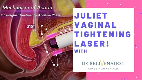 Juliet Vaginal Tightening Laser Girl Talk With Dr Rejuvenation