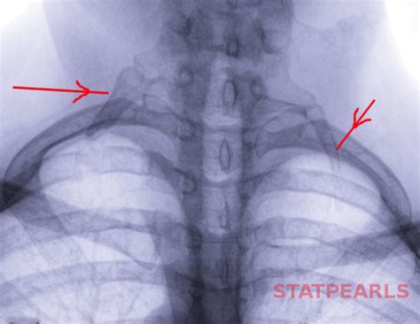 [figure Cervical Rib Image Courtesy S Bhimji Md] Statpearls Ncbi