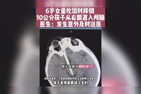 6岁女童吃饭时摔倒 10公分筷子从右眼直入颅脑