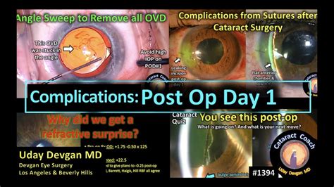 Cataractcoach 1394 Post Op Day One Complications After Cataract Surgery Youtube