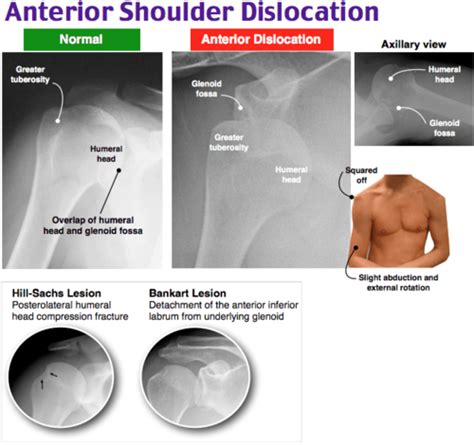 Shoulder And Elbow Flashcards Quizlet