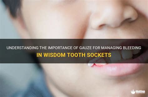 Understanding The Importance Of Gauze For Managing Bleeding In Wisdom