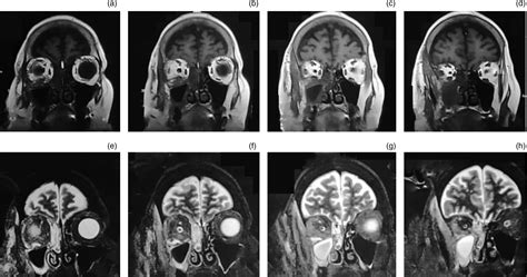 Post Coronavirus Disease Mucormycosis A Deadly Addition To The