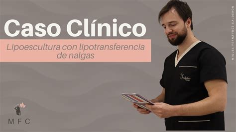 Caso Cl Nico Lipoescultura Con Lipotransferencia De Nalgas Youtube