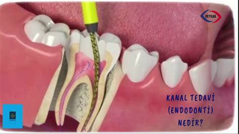 Kanal Tedavisi Endodonti Nedir Podcast Mutlaka Dinleyin Youtube