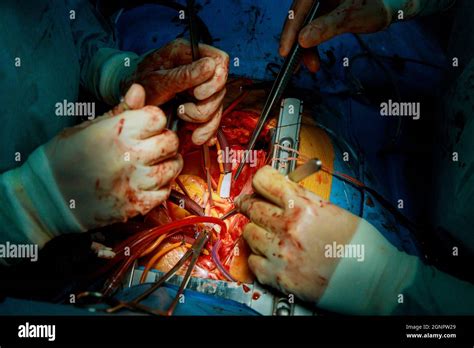 Surgeon Surgery And Team Perform Thoracic Surgery In Case Lung Cancer