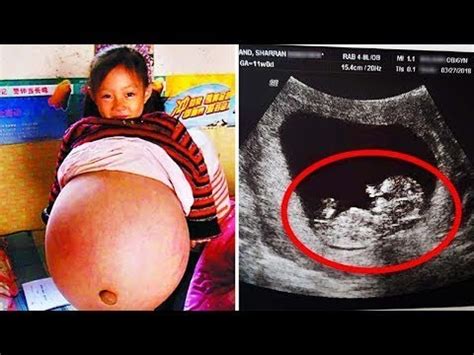 Doctors Think 5 Year Old Girl Has Tumor Turns Out She S Pregnant 1