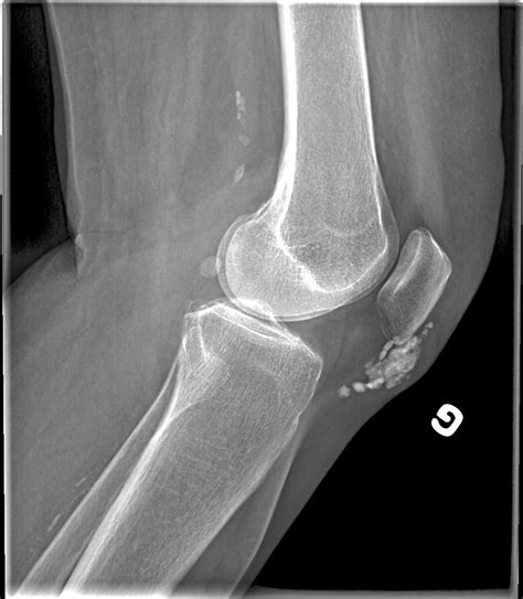 X Ray Of Bursitis In Shoulder At Erin Hopkins Blog