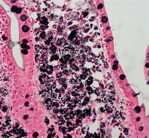 Whipple's Disease, GMS | Ed Uthman | Flickr