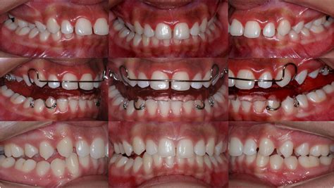 Twin Block And Mandibular Anterior Repositioning Appliances Effects In