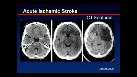 Stroke Ct Scan