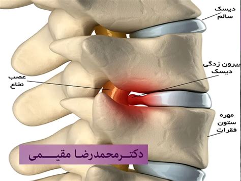 نحوه تشخیص دیسک کمر تست تشخیص دیسک کمر نحوه تشخیص دیسک کمر از روی Mri