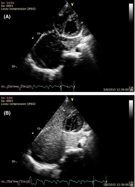 Persistent Left Superior Vena Cava In Atrial Septal Defect Sinus