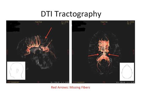 MRI_DTI | The Flomenhaft Law Firm, PLLC