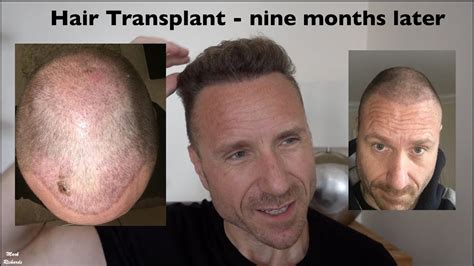 Female Hair Transplant in Turkey – Pagan Path