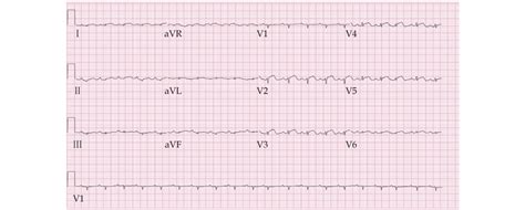 12 lead EKG significant for normal sinus rhythm, low voltage QRS ...