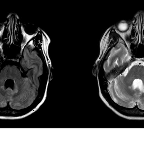 Combined Ebv Cmv And Hsv T2 And Flair Axial Images Show Patchy Download Scientific Diagram